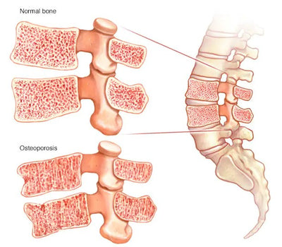Osteoporosis how to limit its effects!